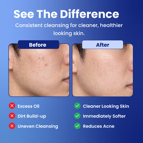 Before and after comparison graphic showing a person's cheek with acne, under the heading 'See The Difference' on a blue gradient background. The left panel is labeled 'Before' and shows skin with blemishes; the right panel is labeled 'After' and shows clearer skin.